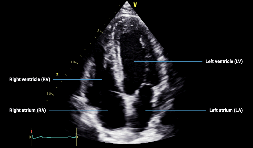apical four-chamber view
