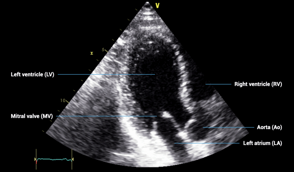 apical three-chamber view