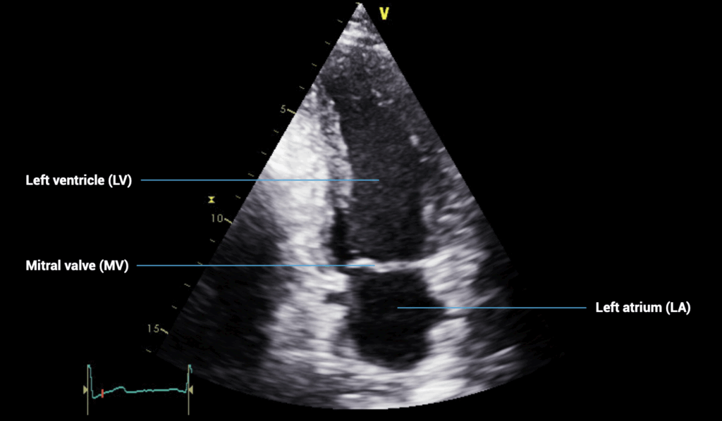 apical two-chamber view