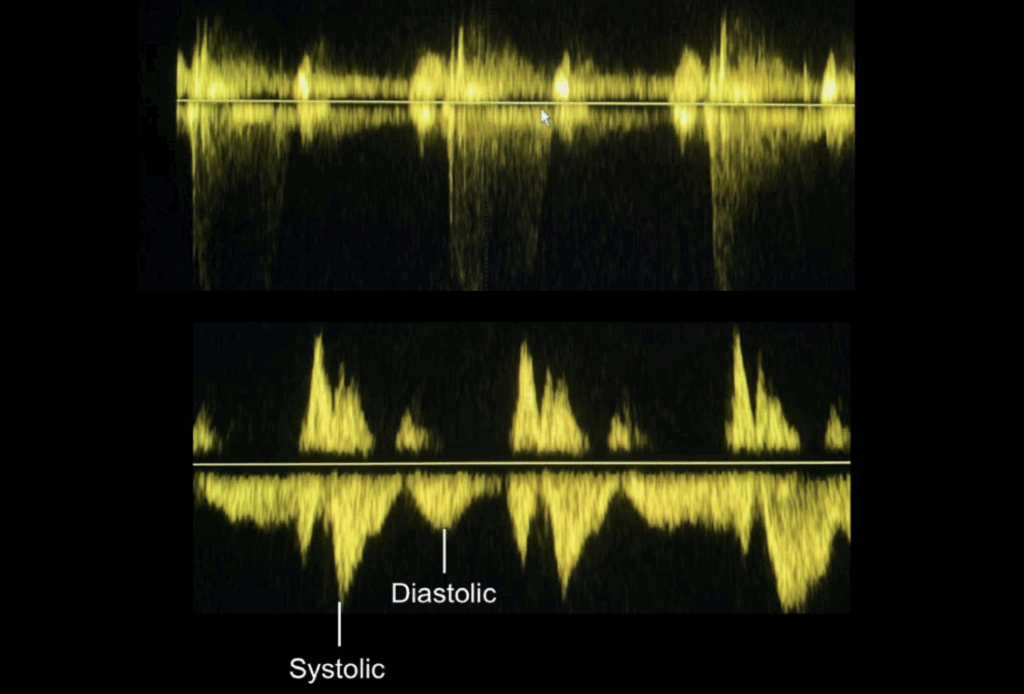 colour and spectral Doppler TR