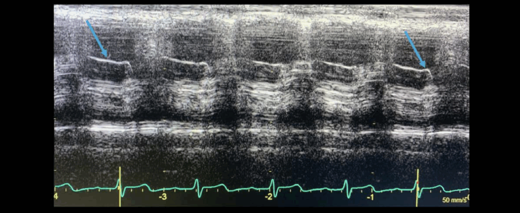 distinctive notch occurring in the valve M-mode profile