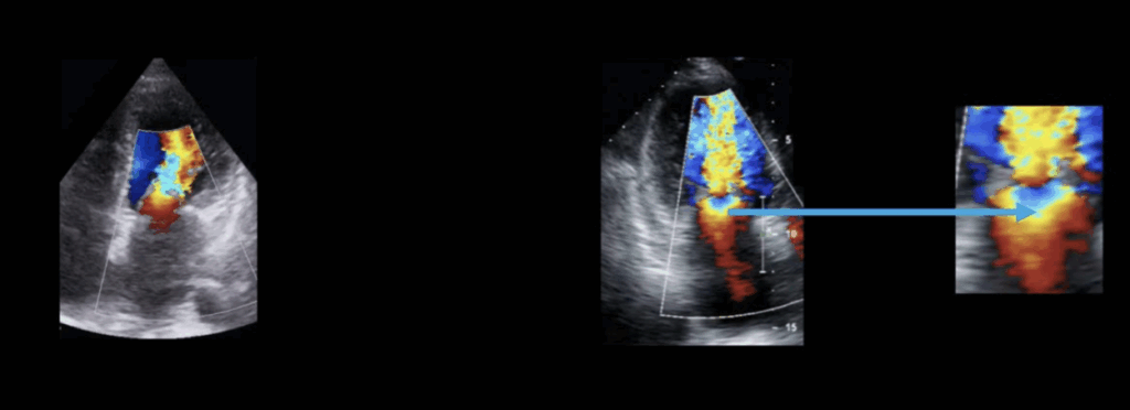 grading mitral stenosis