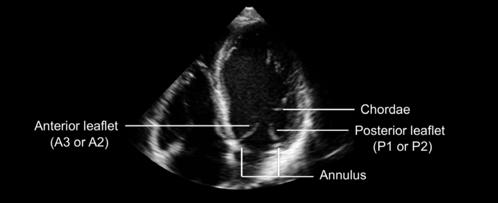 mitral valve apical 2-chamber