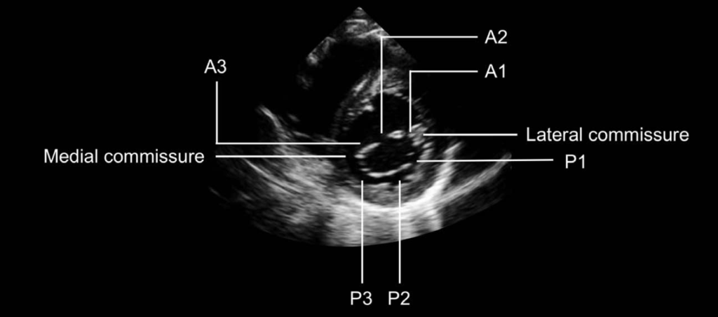 mitral valve apical 4-chamber
