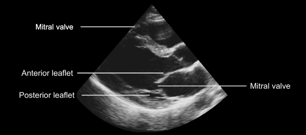 mitral valve echo normal