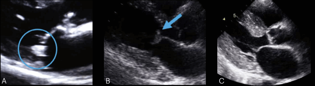 mitral valve pathology