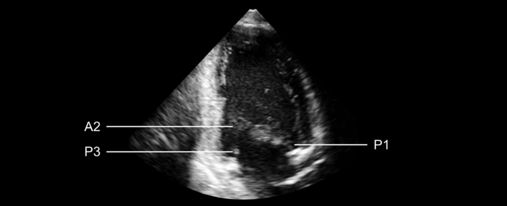 mitral valve apical 3-chamber