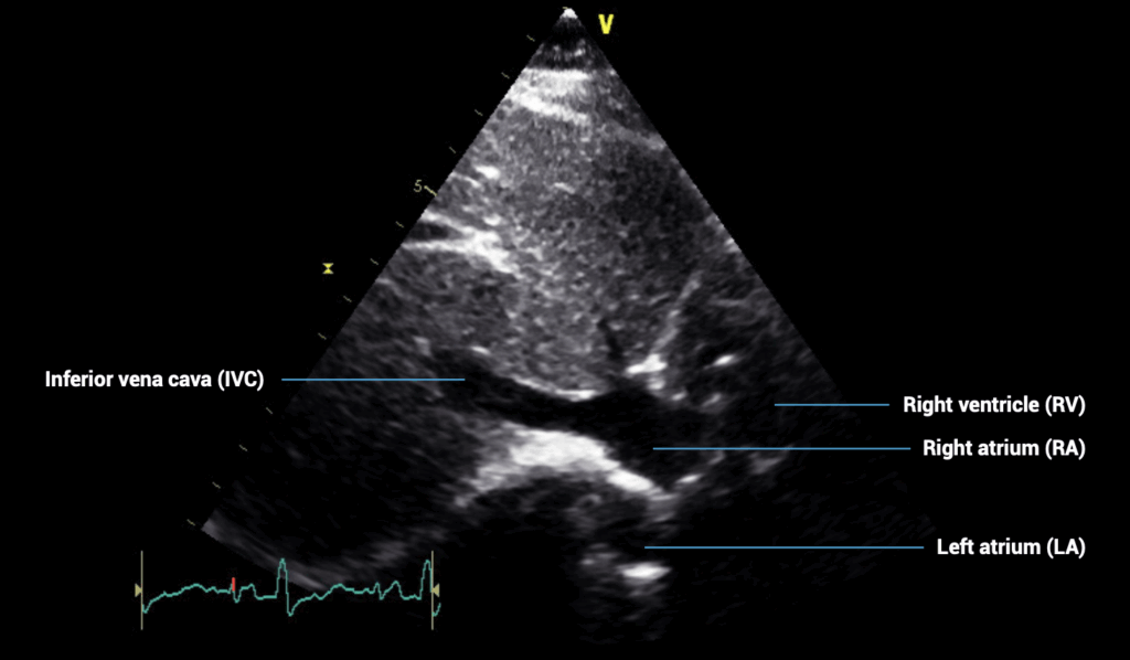 subcostal IVC view