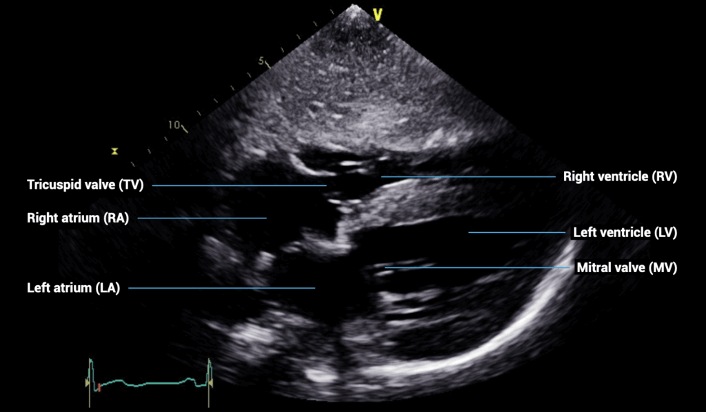 subcostal four-chamber view
