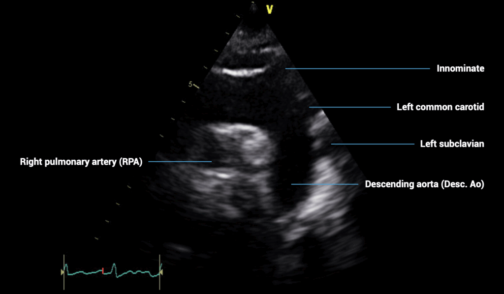 suprasternal view of the aorta 2
