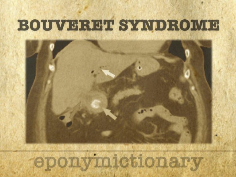 Bouveret Syndrome 680