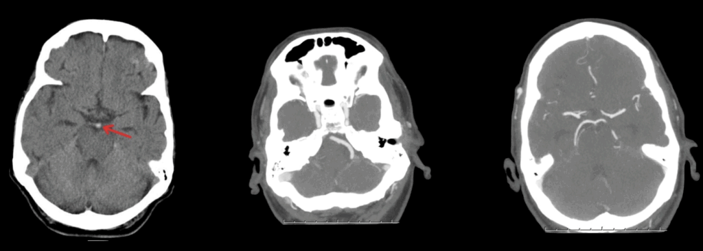 Case study 1 basillar artery stroke