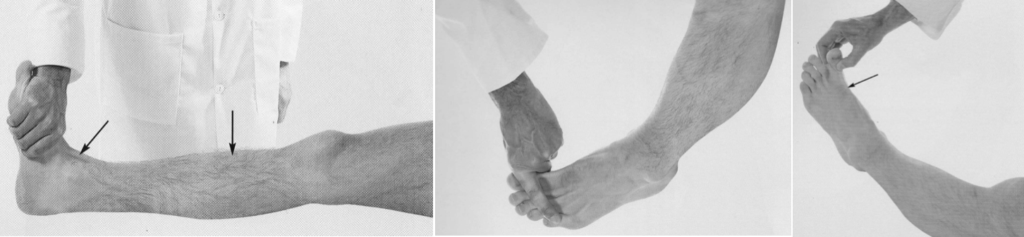 Common Peroneal Nerve examination 1