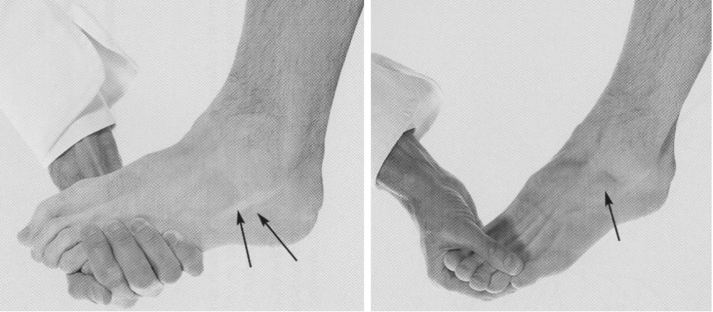 Common Peroneal Nerve examination 3