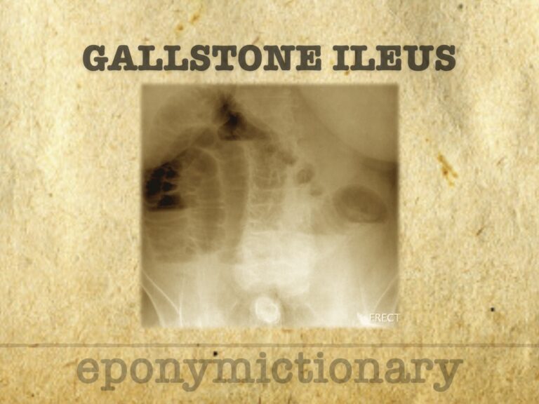 Gallstone Ileus 680