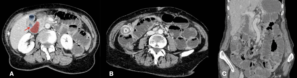 Gallstone ileus Radiopaedia