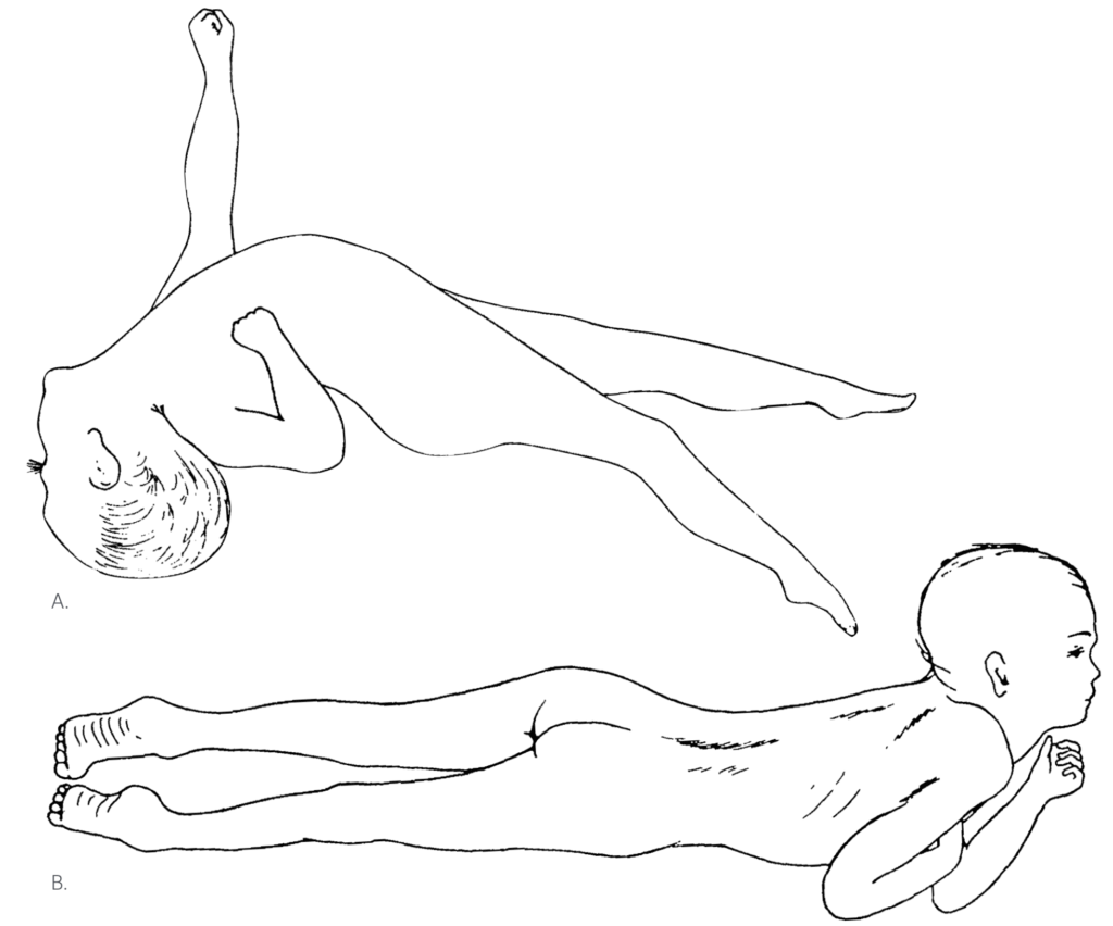 Jackson Cerebellar Seizures