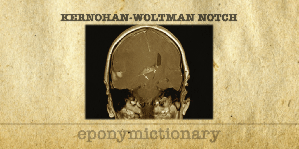 Kernohan-Woltman Notch Phenomenon • LITFL