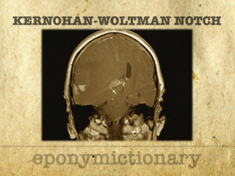 Kernohan-Woltman Notch Phenomenon 680