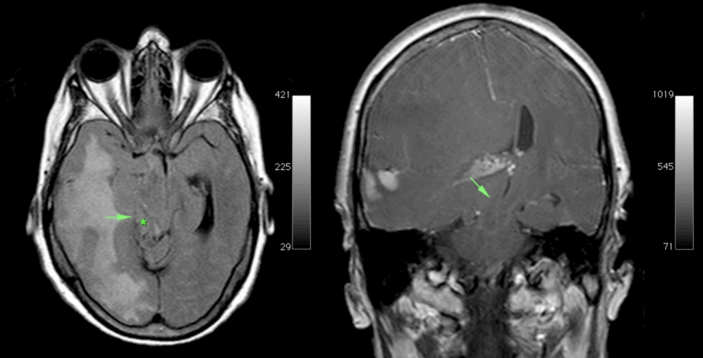 Kernohan phenomenon Radiopaedia