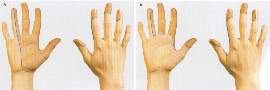 Median nerve sensory changes