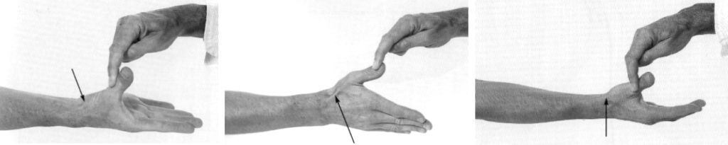 Radial Nerve examination 1