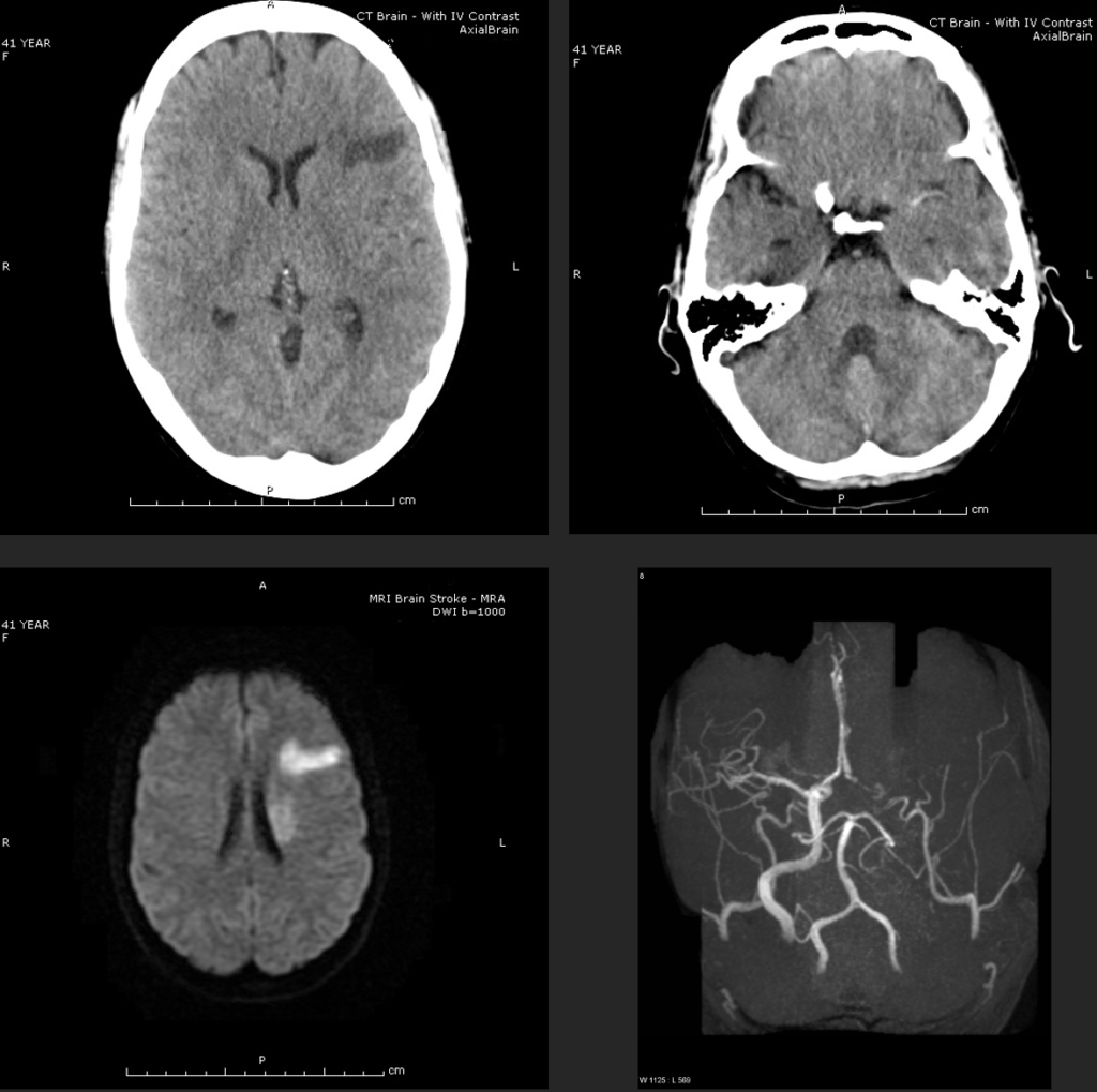 Stroke case study 1