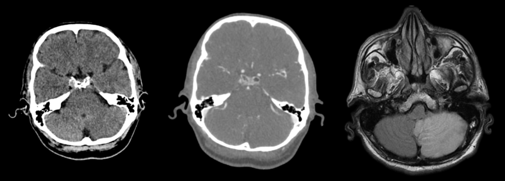 case study 1 posterior circulation stroke