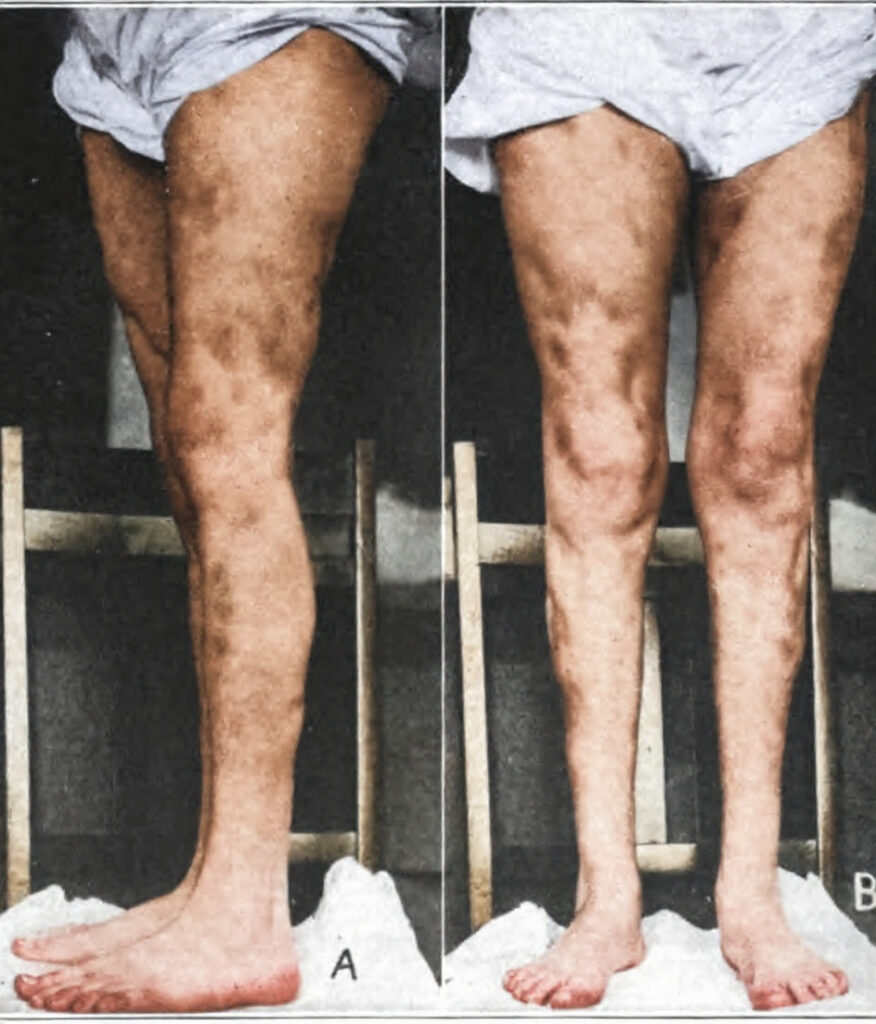deep irregular depressions in the cutaneous surface
