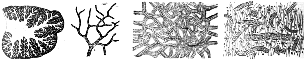 Deposit of pigment in the brain in cases of malarial fever, Jones 1887