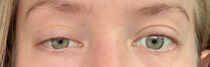 Horner right ptosis miosis