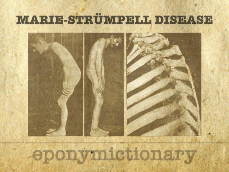 Marie-Strümpell disease 680