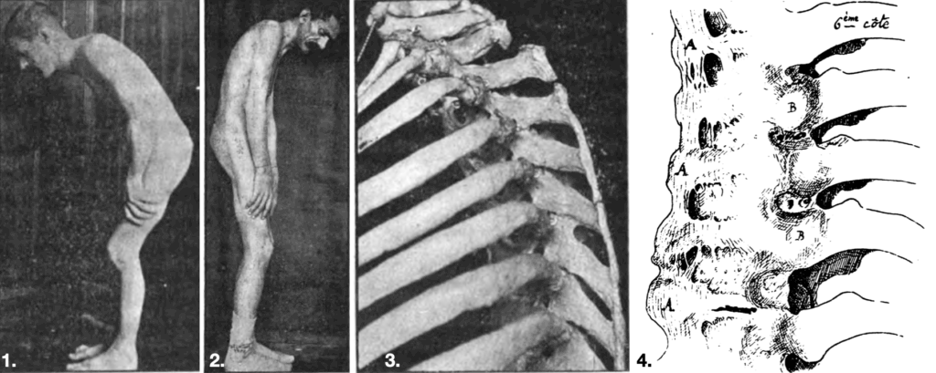 Marie-Strümpell disease 1898