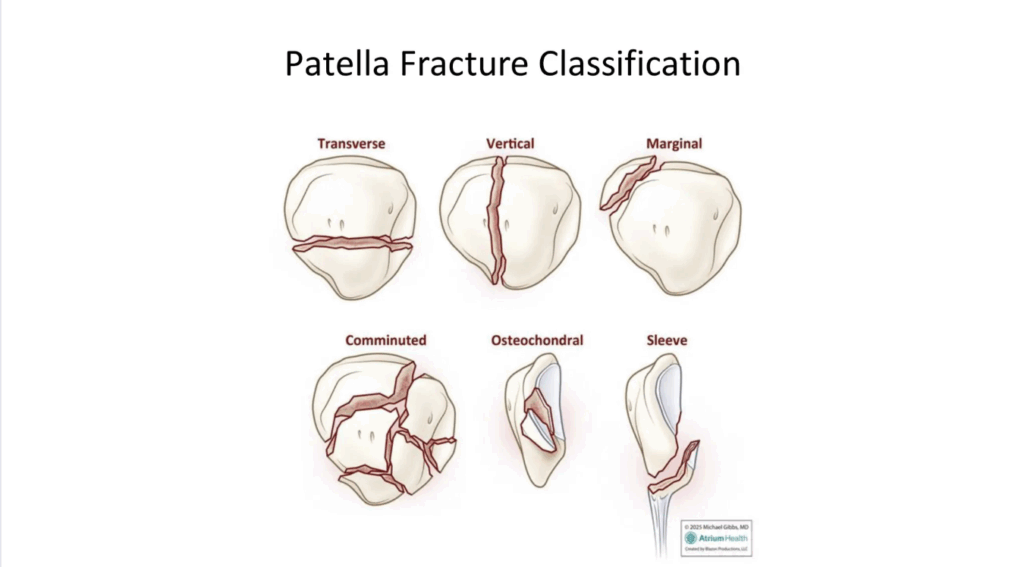 patella fracture classification