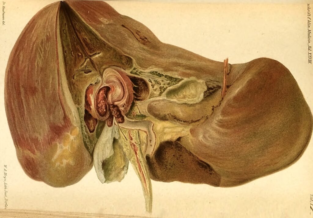 hemorrhage in the liver causing hemobilia - Mester 1895.jpeg