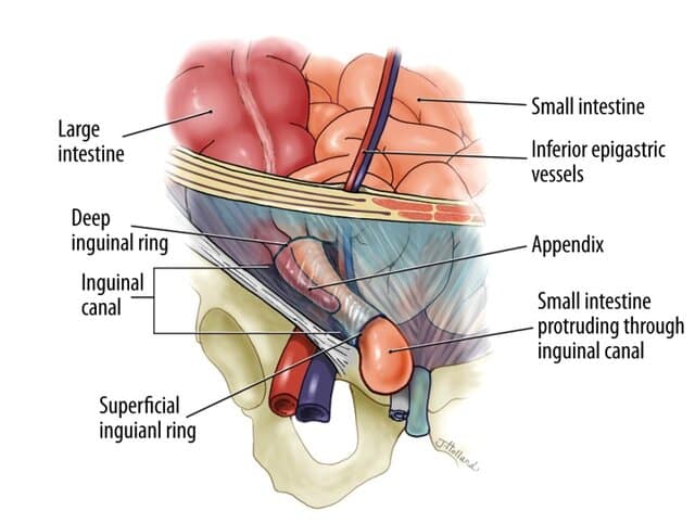 Amyand’s hernia