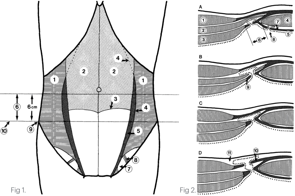 Spigelian hernia anatomy 1989