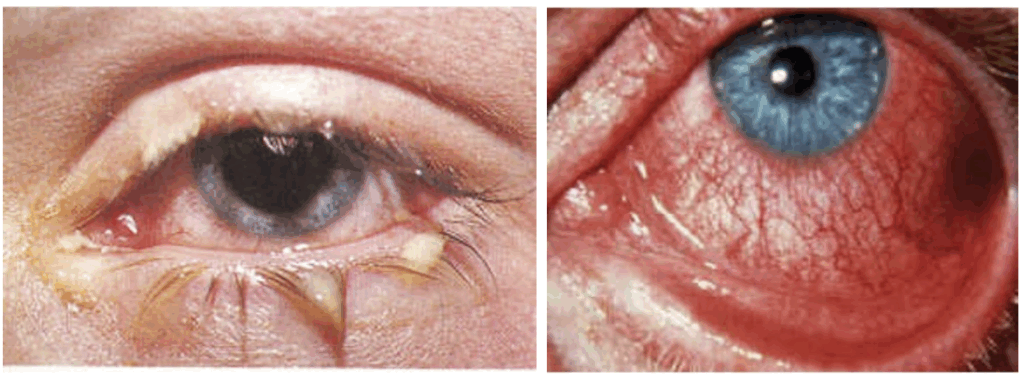 Acute Conjunctivitis 1