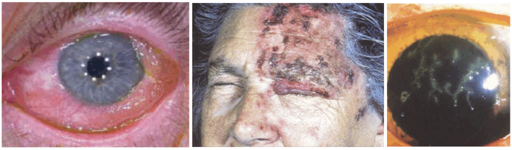 Acute Conjunctivitis 2