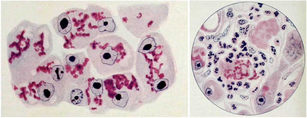 Alcoholic cirrhosis Mallory Bodies 1914