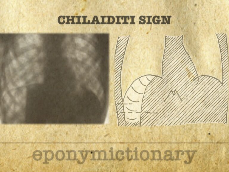 Chilaiditi sign and syndrome