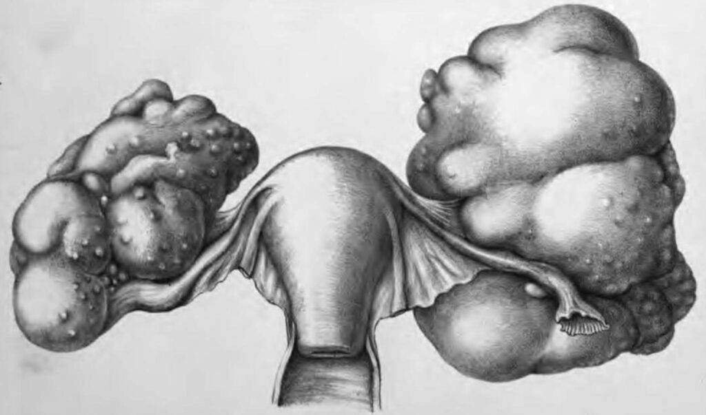 Cullingworth Fibroma of both ovaries 1879