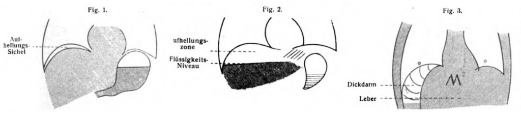 Popper 1915 abdominal viscus perforation vs Chilaiditi