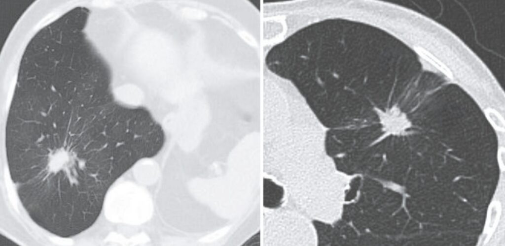 Rigler pleural tail sign and Rabbit ear sign
