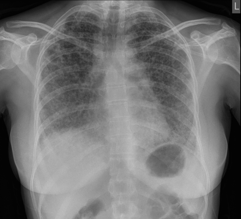 asbestosis radiopaedia