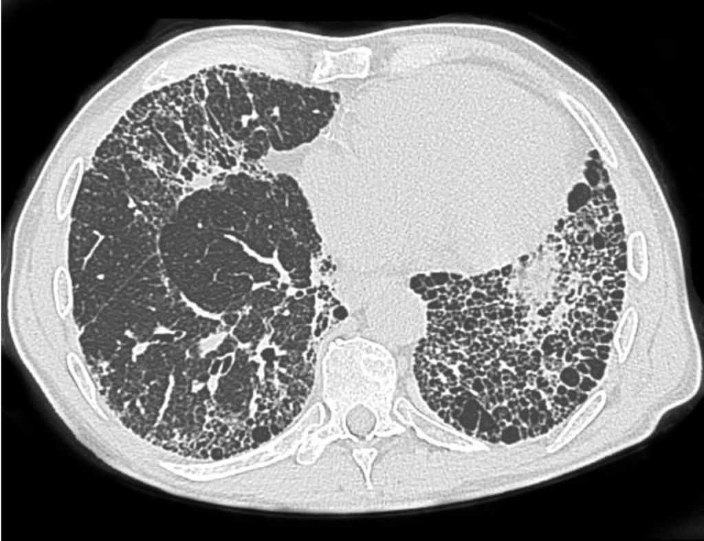 asbestosis radiopaedia CT