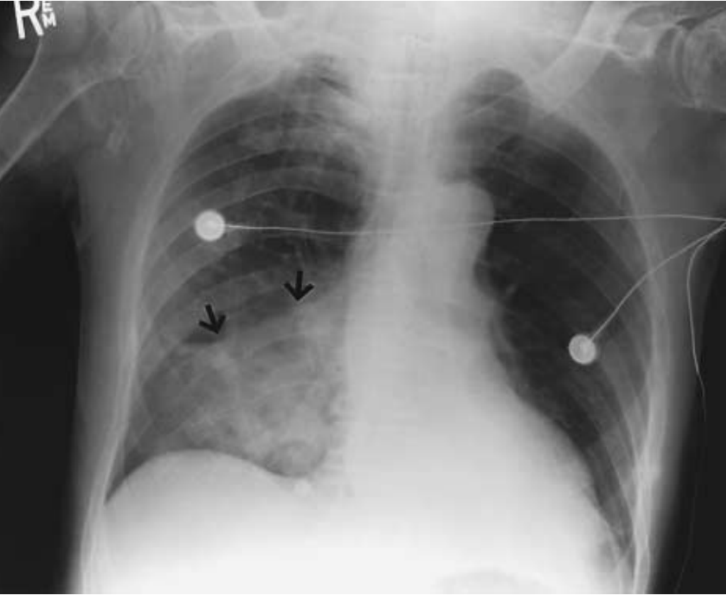 aspiration pneumonia