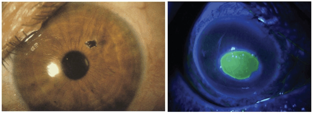 corneal foreign body 1