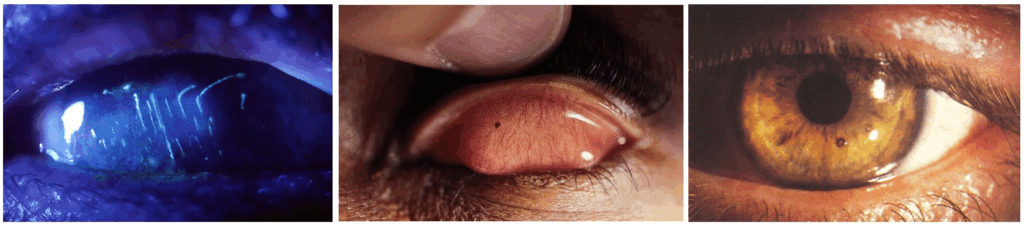 corneal foreign body 2