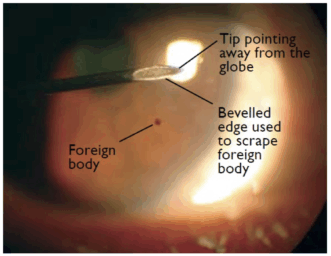 Corneal foreign bodies • LITFL • FFS